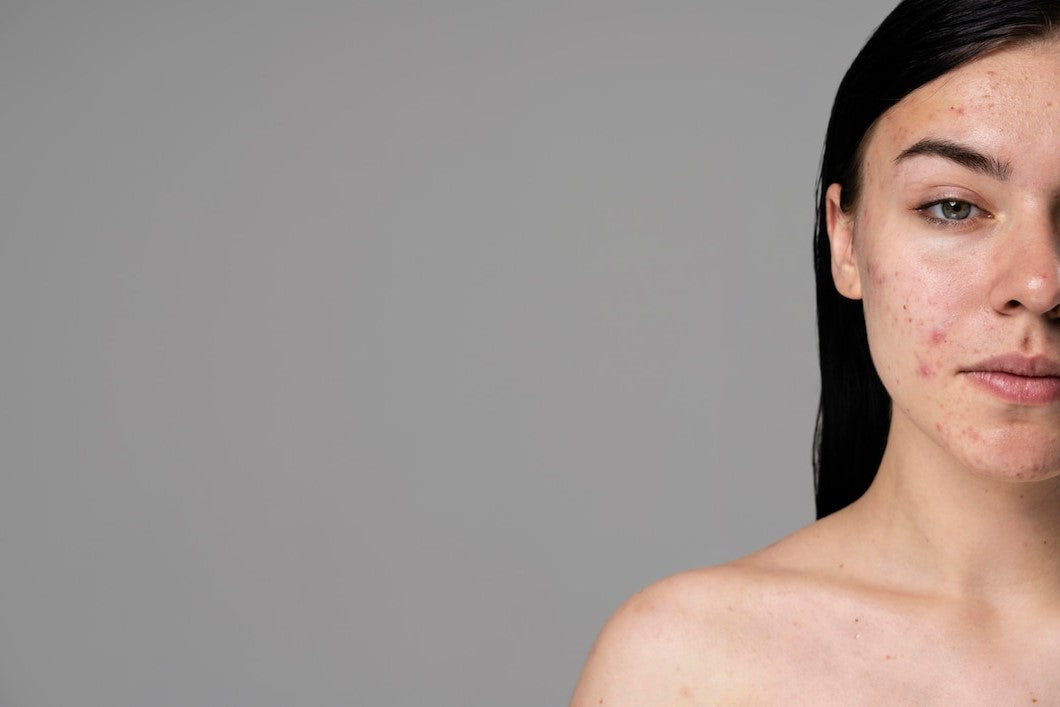 Acne & Pimples: Causes, Treatments, and Skincare Tips for Clearer Skin