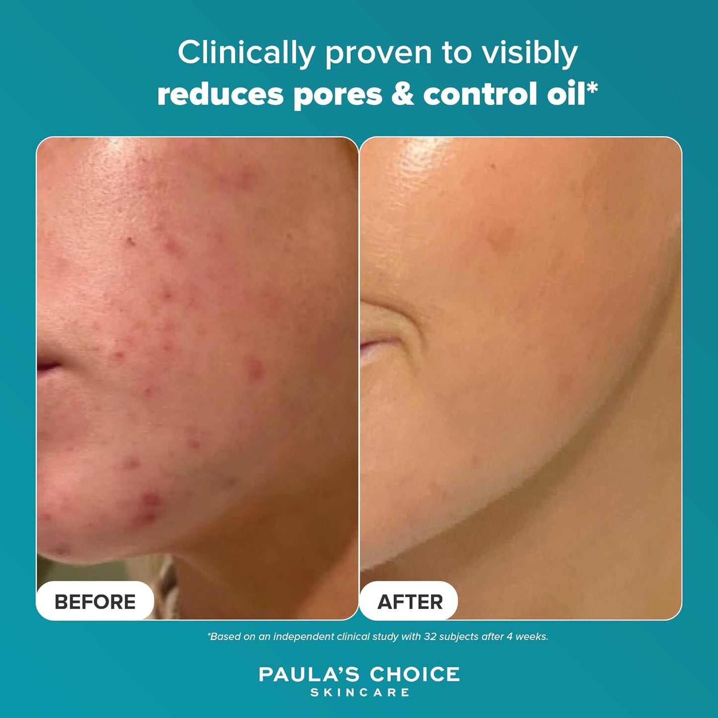 Paula's Choice SKIN PERFECTING 2% BHA Liquid Exfoliant - Face Exfoliating Peel Fights Blackheads & Enlarged Pores - for a Healthy Glow - with Salicylic Acid - Combination & Oily Skin - 30 ml, Premium Beauty, Buy skincare products online in UK at luxsupp.com