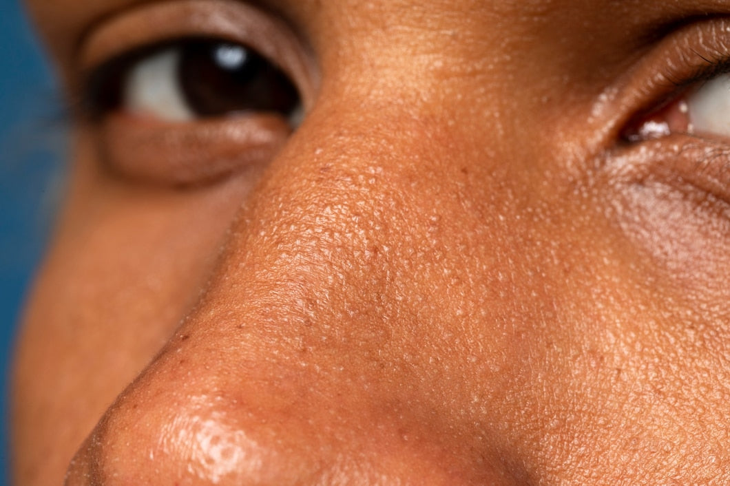 Blackheads vs. Whiteheads: What’s the Difference and How to Treat Them?