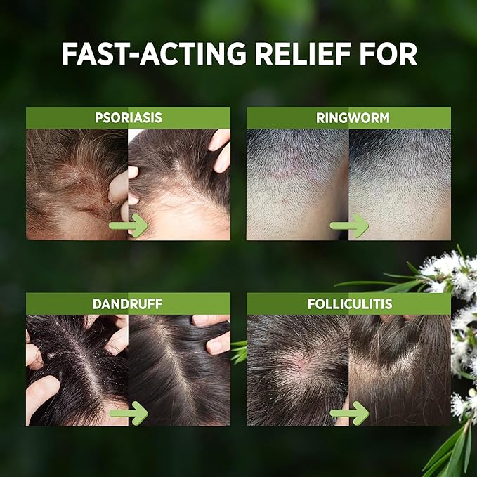 RoyceDerm Tea Tree Scalp Relief Spray 120Ml